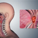 Why Oral Sex Has Become the Primary Risk Factor for Throat Cancer. Photo Courtesy
